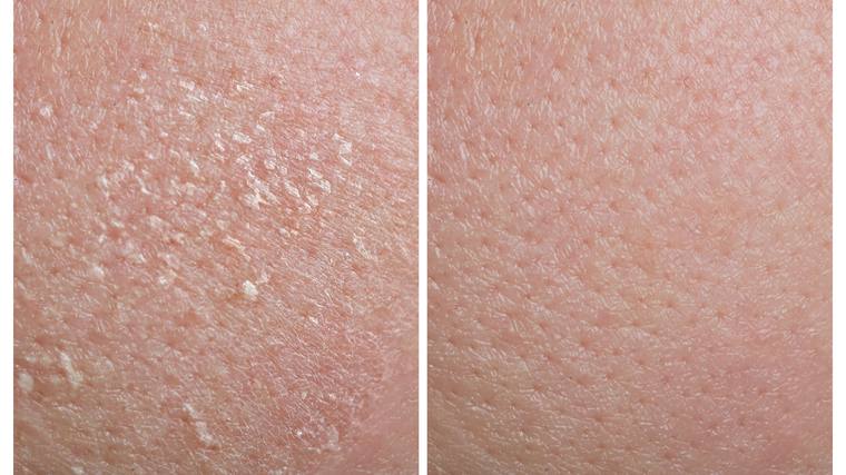 A close-up of dry, flaking skin beside the same skin smooth and evenly textured